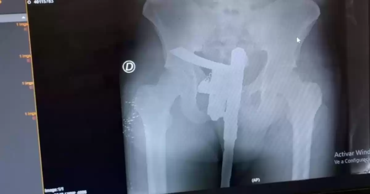 Se hizo una radiografía con un arma entre los genitales
