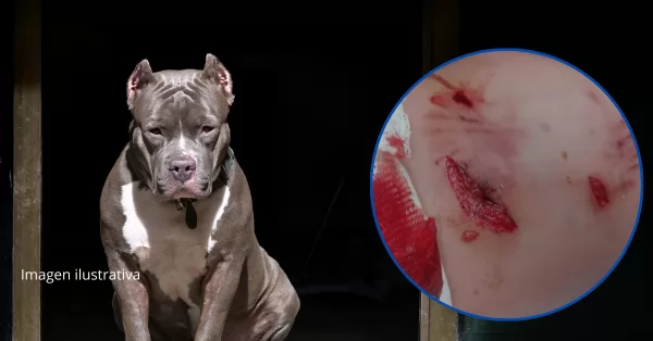 Un pitbull atacó a un niño de 11 años en Roldán y resultó con heridas graves