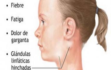 MONONUCLEOSIS INFECCIOSA EN LOS NIÑOS