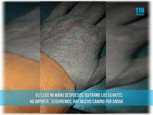 Viral: la imagen de la mano de una enfermera santafesina luego de horas de trabajo