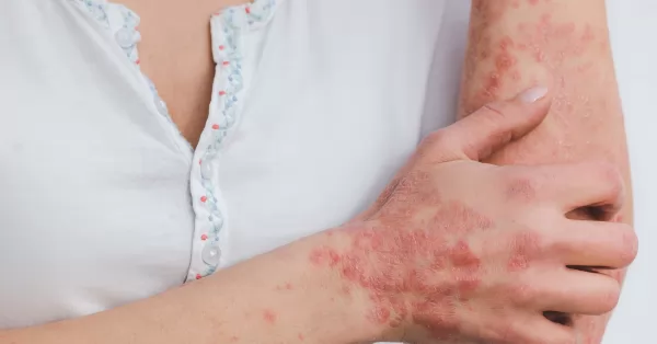 La ANMAT aprobó un nuevo medicamento para la psoriasis 